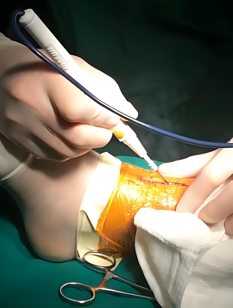 Metal Dome for Medical Electric Knife Pen (ESU)